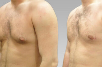 Убрать жир с груди мужчине: фото.