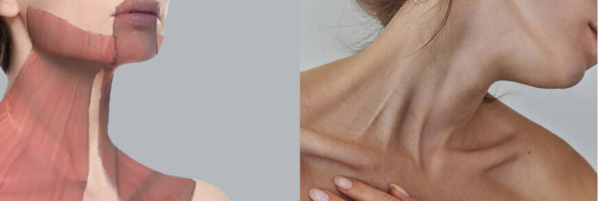 Мышца платизма: постер.