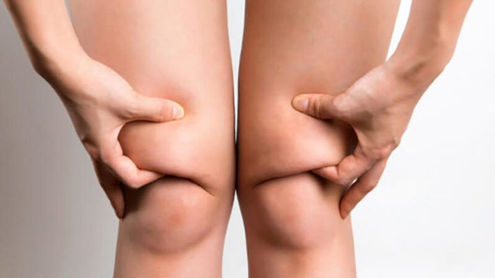 Как убрать нависшие колени: упражнения и фото.