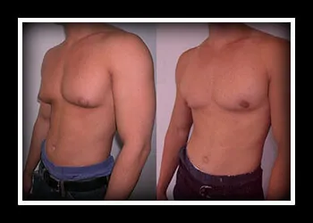 Как убрать жир с грудных мышц мужчинам: рекомендации и тренинг