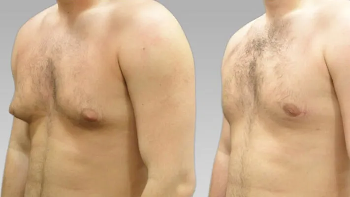 Убрать жир с груди мужчине: фото.