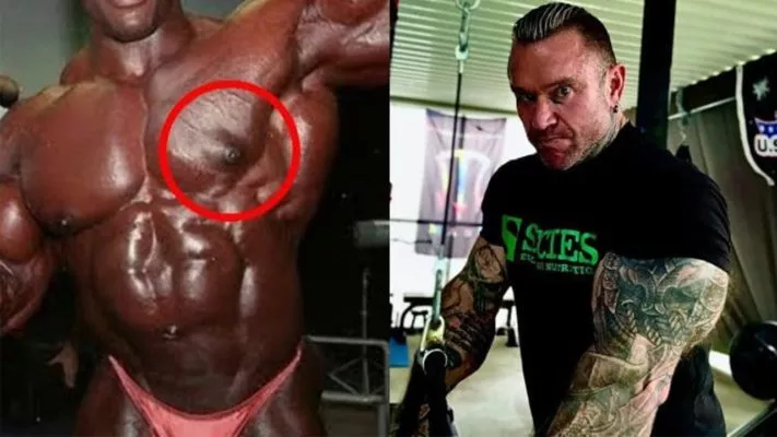 Гинекомастия у Ли Приста: фото.