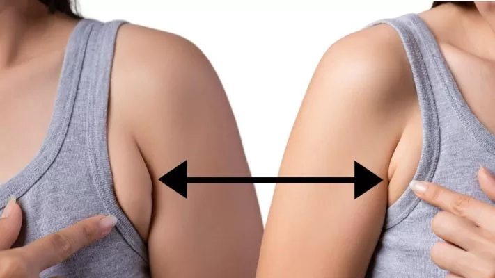Как убрать жир с подмышек: фото.